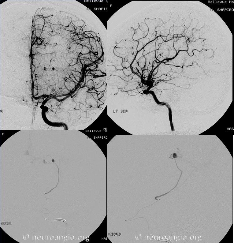 http://www.neuroangio.org/wp-content/uploads/ACh/ACh_Aneurysm_Perinidal_Posterior_Limb.png