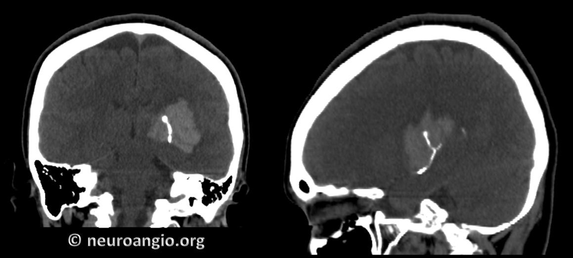 http://www.neuroangio.org/wp-content/uploads/ACh/ACh_Aneurysm_Perinidal_Posterior_Limb_CT.png