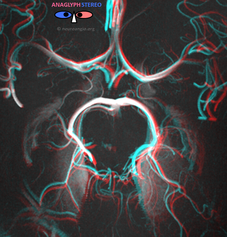 Spinal Vascular Anatomy Neuroangio Org
