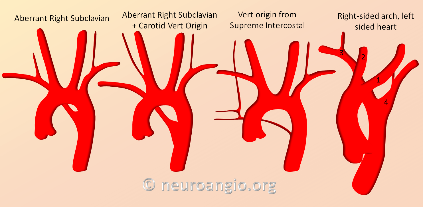 Really useful aortic arch variants