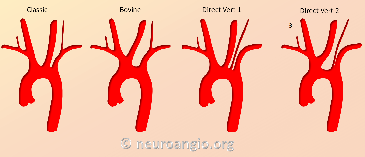 Aortic arch common variants