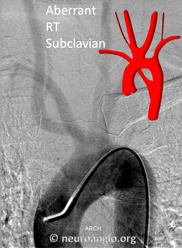 Aberrant Right Subclavian