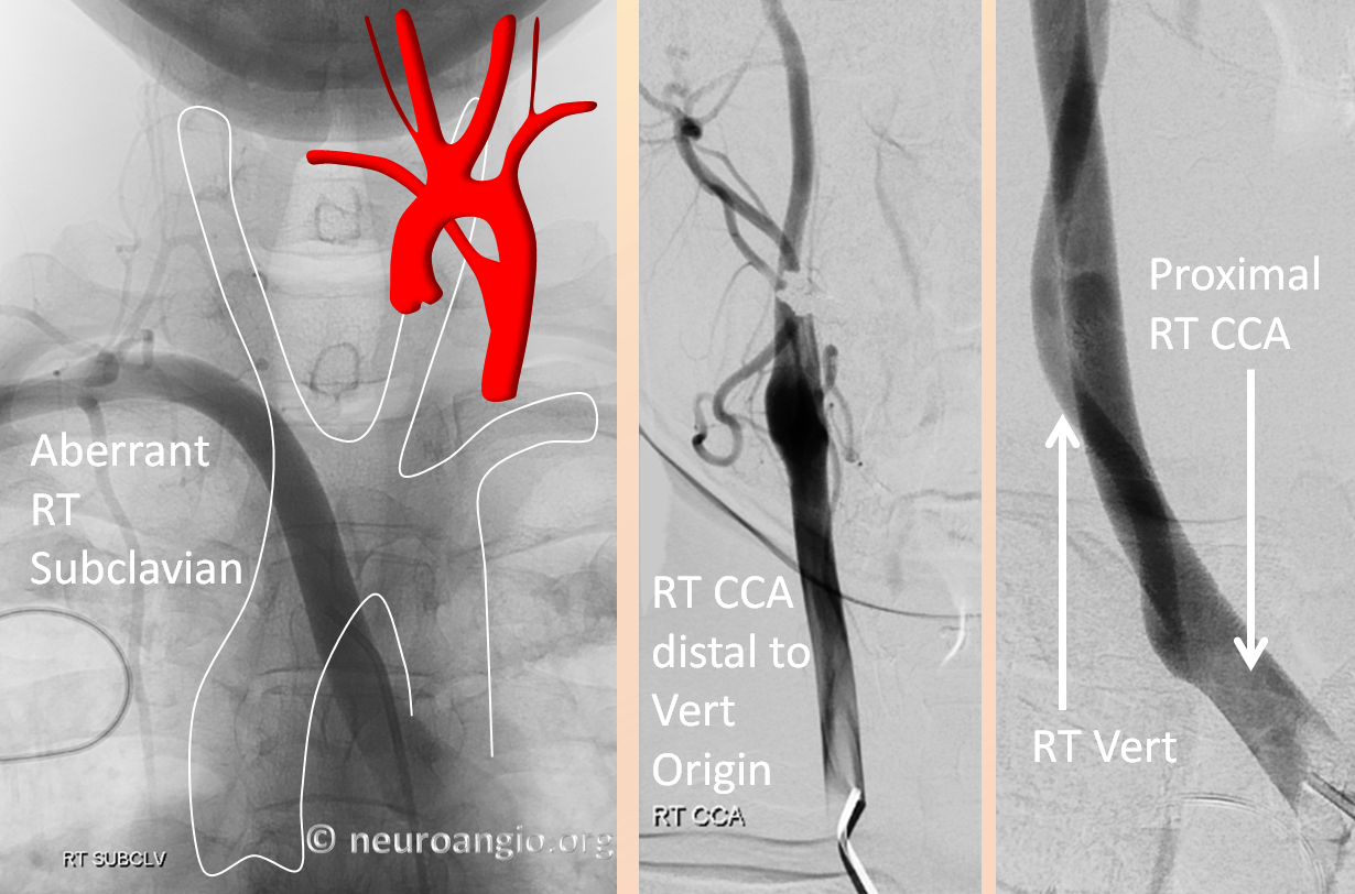 Aberrant RIGHT subclavian