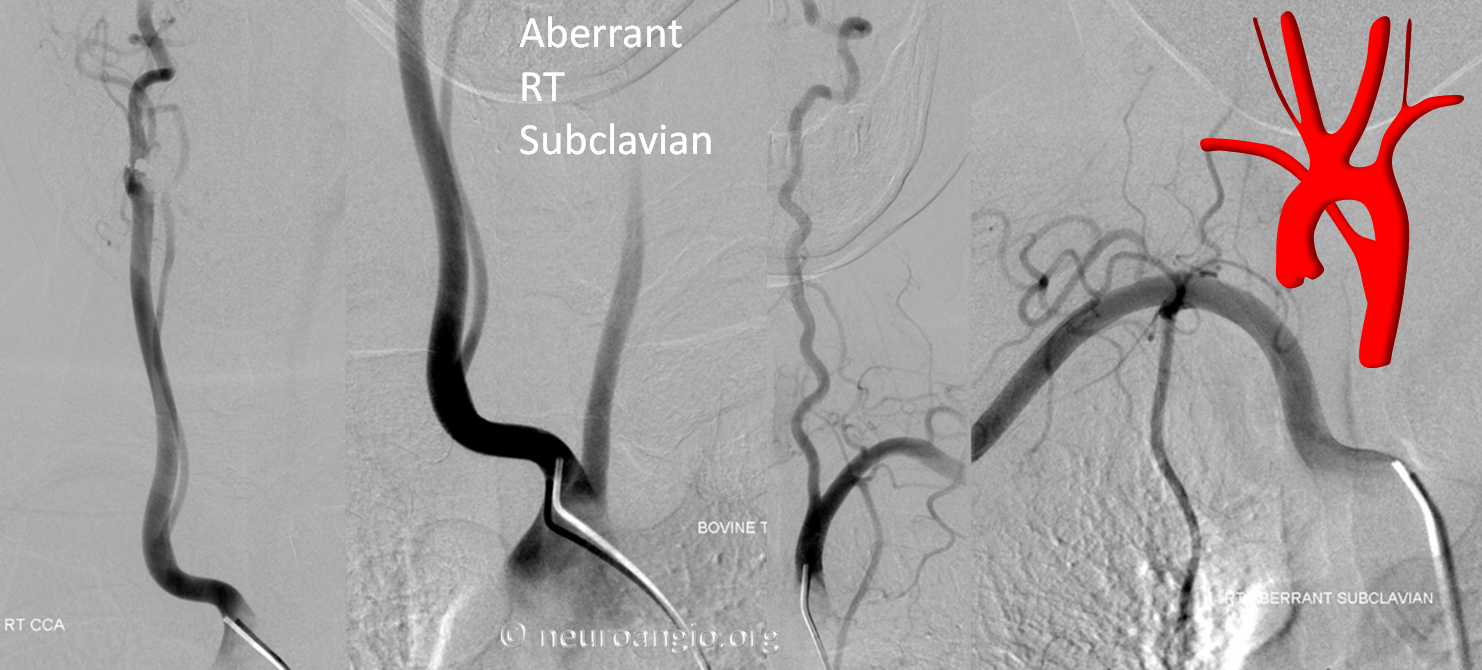 Aberrant RIGHT subclavian