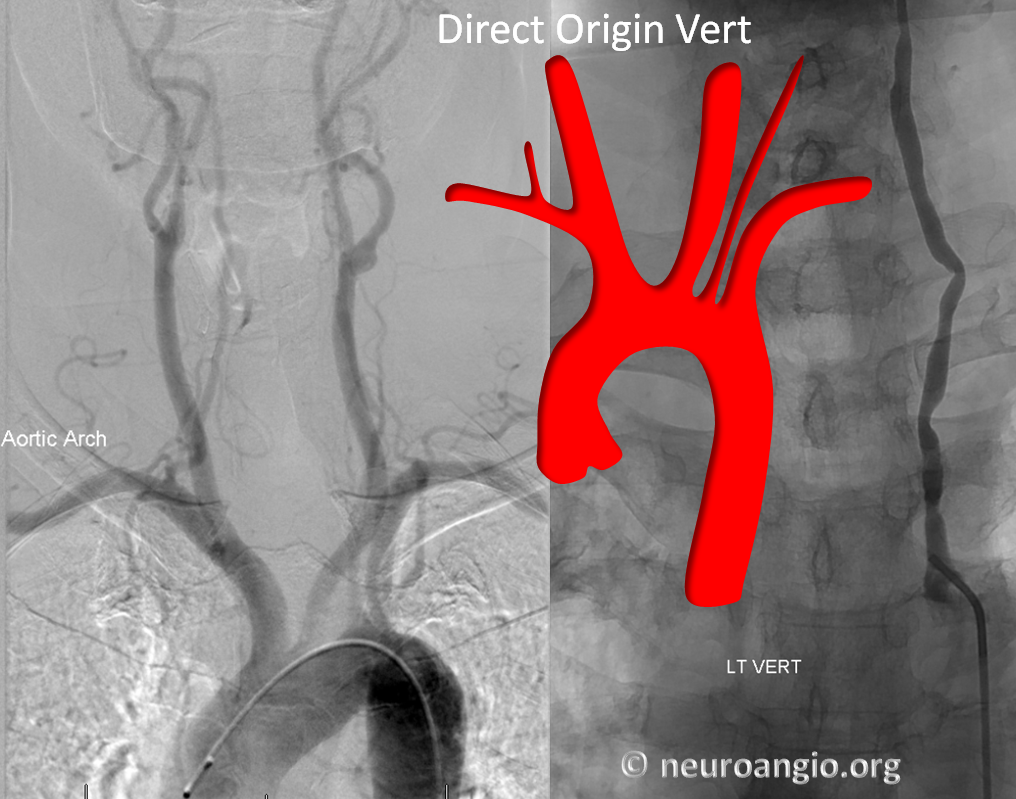 direct origin left vertebral artery