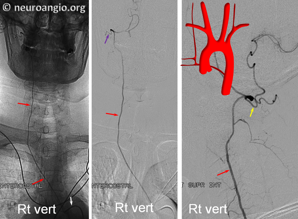 Supreme Intercostal Origin Right Vert