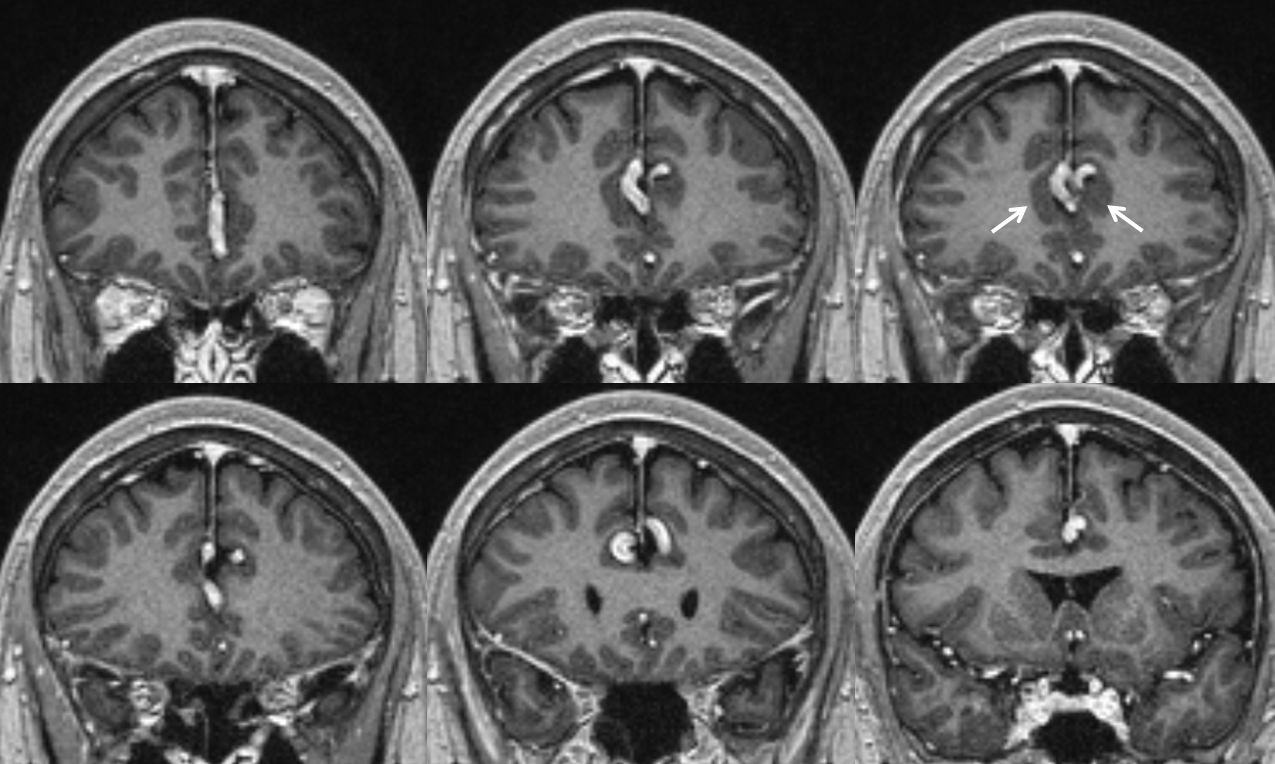 Pure Arterial Malformation | neuroangio.org