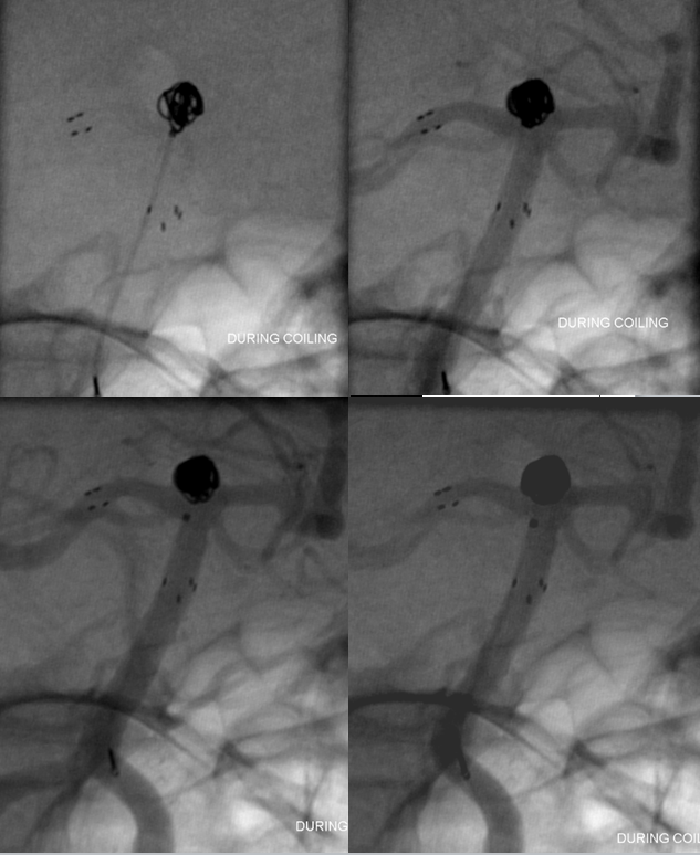 Neuroform-EZ stent-supported coiling