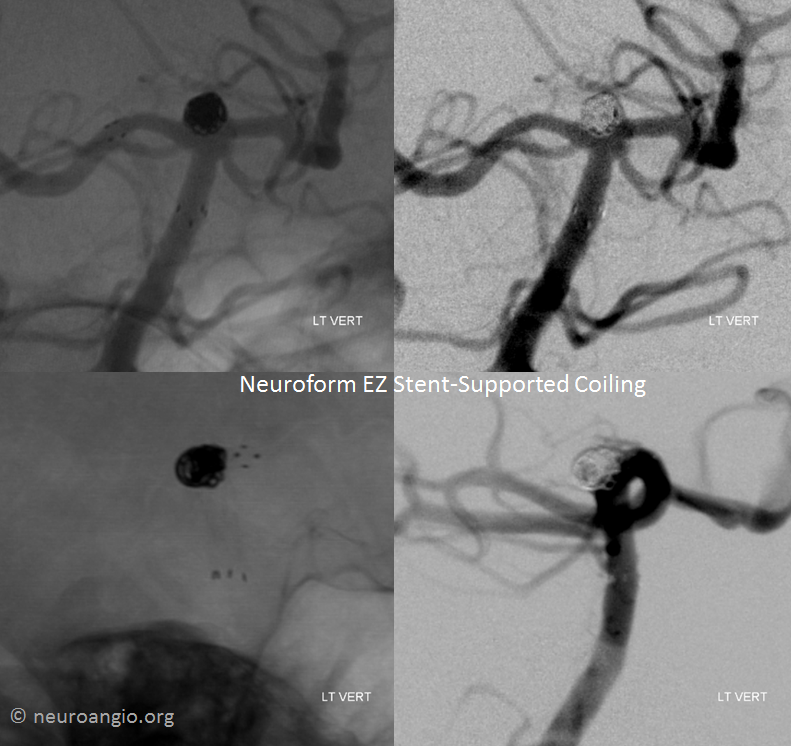 Neuroform EZ stent-supported coiling
