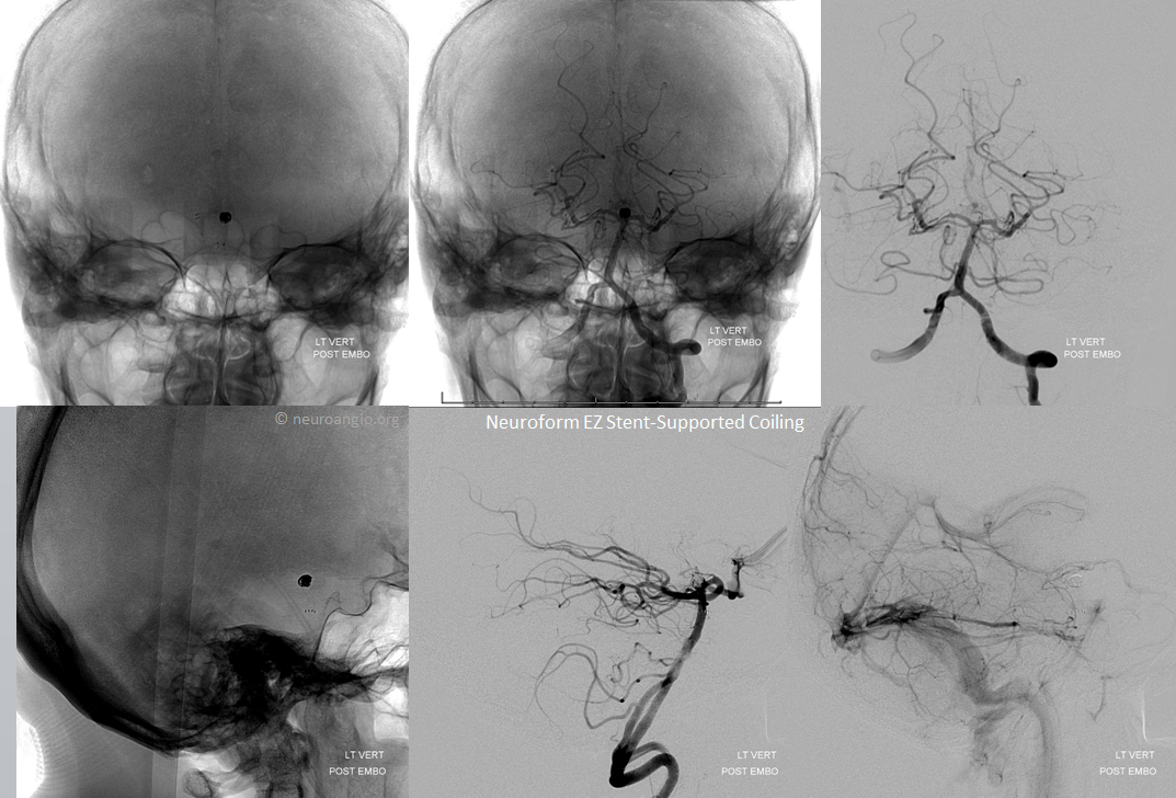 Neuroform EZ stent-supported coiling