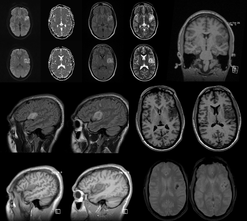 http://www.neuroangio.org/wp-content/uploads/Archives/Archives-Carotid-Web-1.PNG