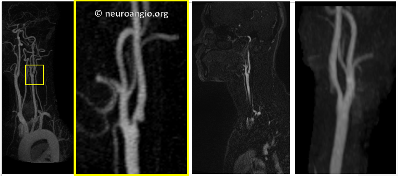 http://www.neuroangio.org/wp-content/uploads/Archives/Archives-Carotid-Web-3.PNG