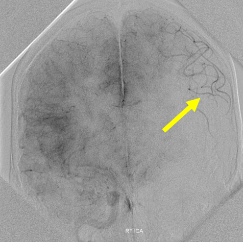 http://www.neuroangio.org/wp-content/uploads/Archives/Archives-Carotid-Web-4.PNG