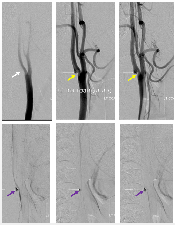 http://www.neuroangio.org/wp-content/uploads/Archives/Archives-Carotid-Web-5.PNG