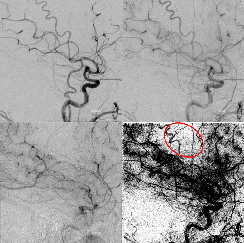 http://www.neuroangio.org/wp-content/uploads/Archives/Archives-Carotid-Web-6.PNG