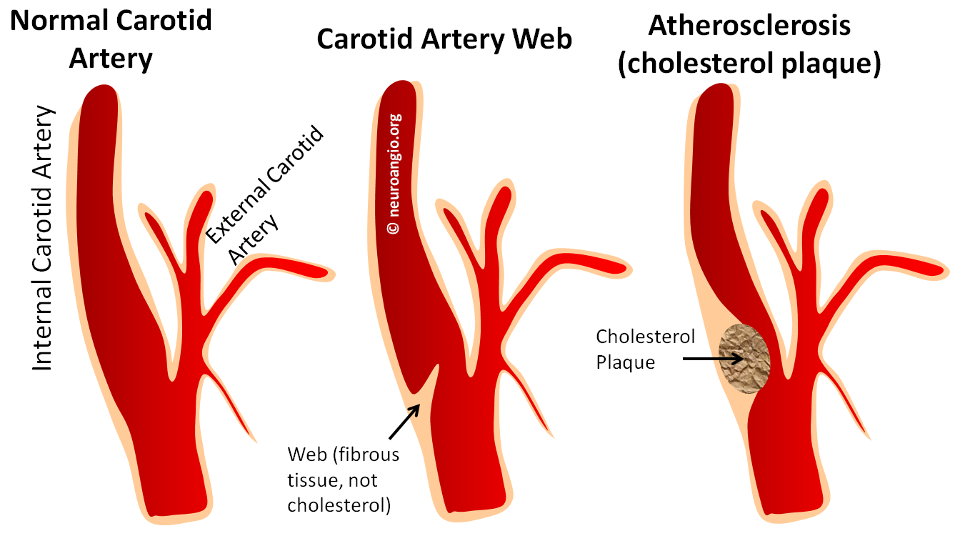 Carotid Artery Web