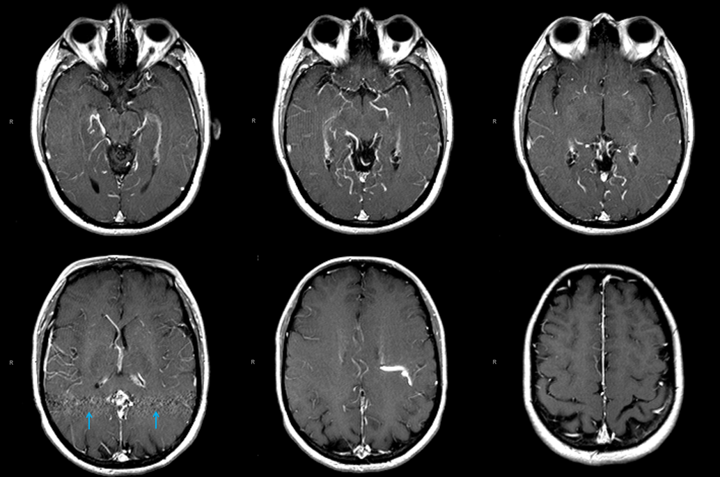 falcotentorial dural fistula