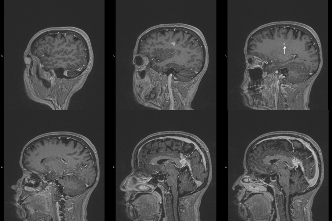 falcotentorial dural fistula