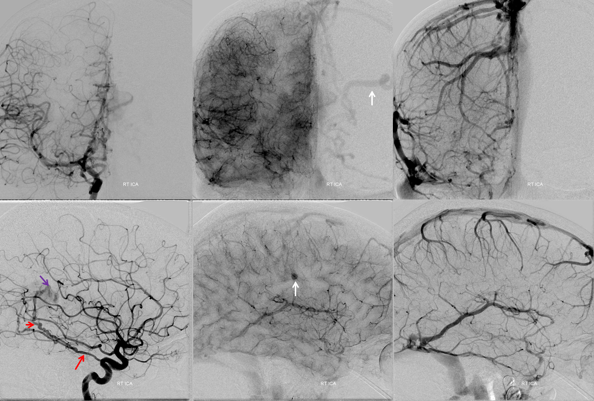 falcotentorial dural fistula