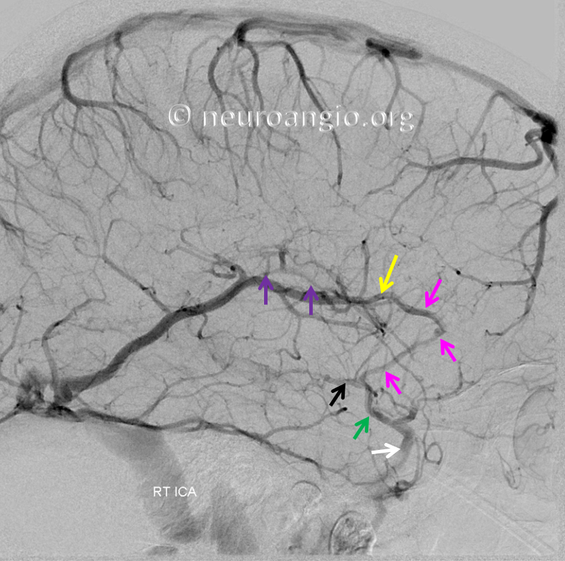 falcotentorial dural fistula