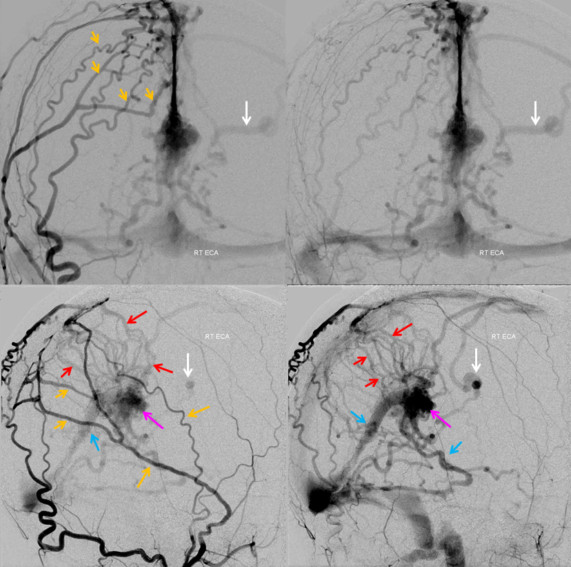 falcotentorial dural fistula