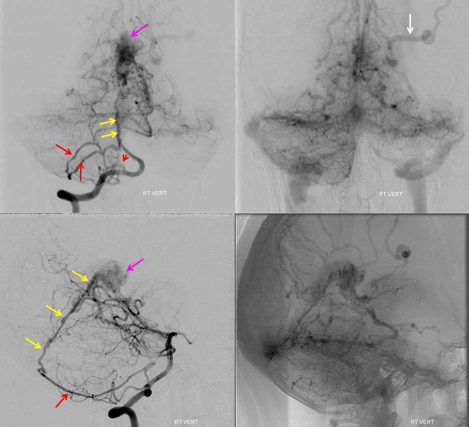 falcotentorial dural fistula