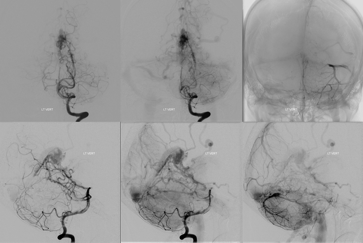 falcotentorial dural fistula