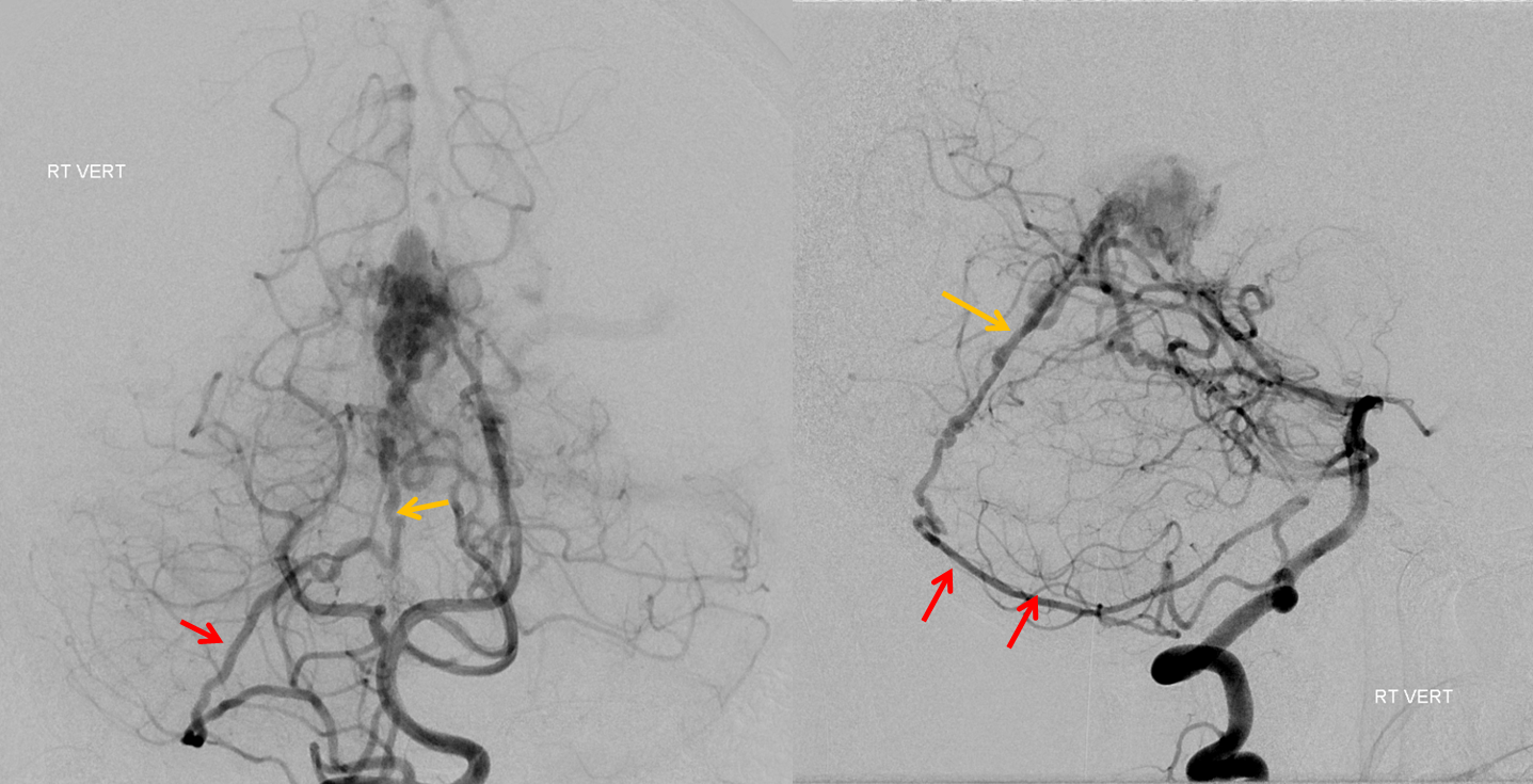 falcotentorial dural fistula