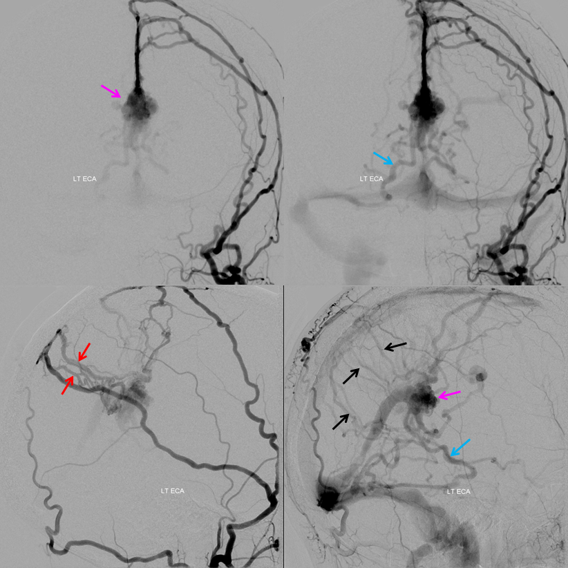 falcotentorial dural fistula