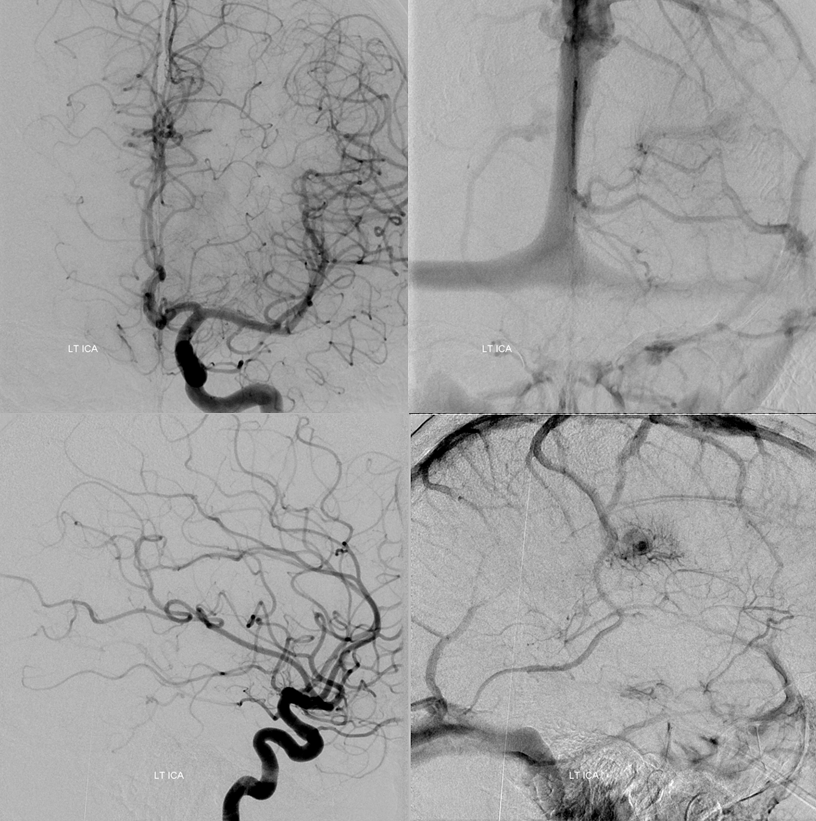 falcotentorial dural fistula