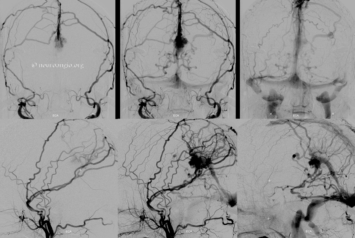 falcotentorial dural fistula