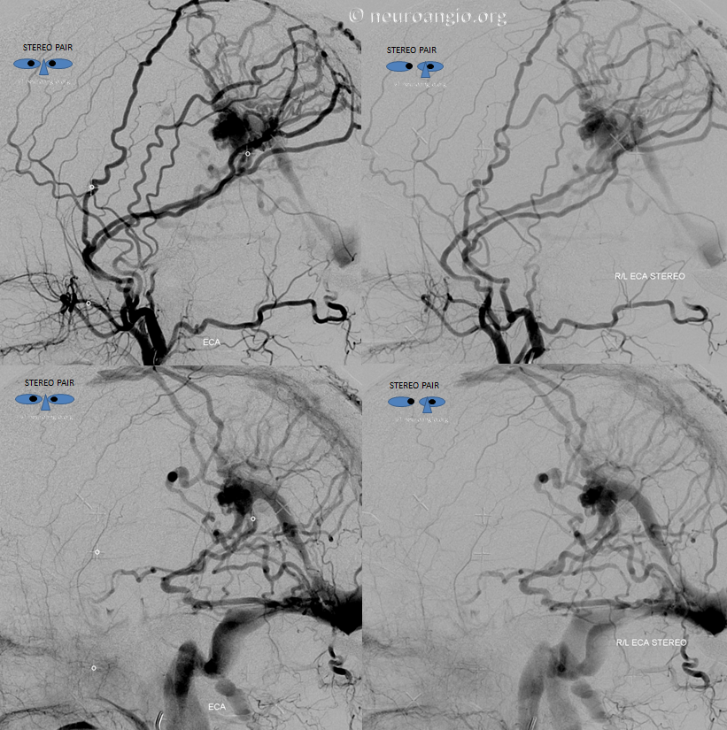 falcotentorial dural fistula