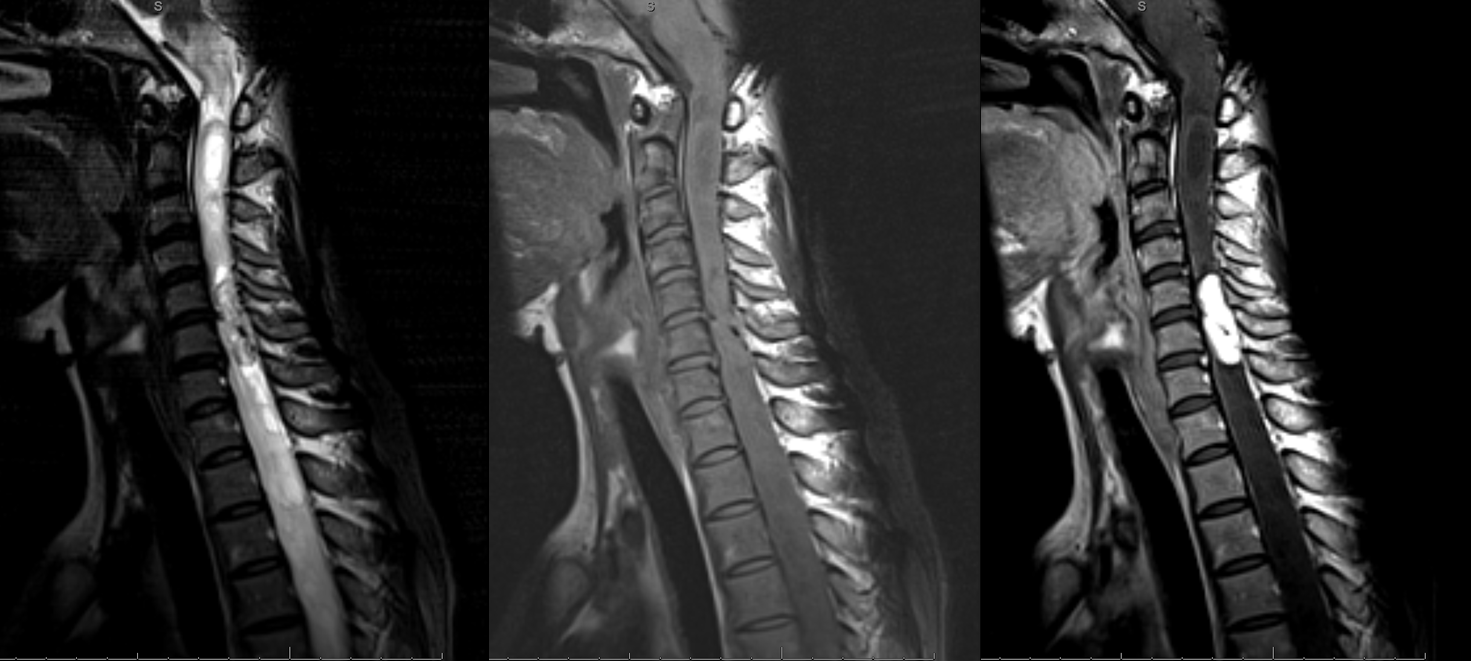 MRI preop hemangiopericytoma