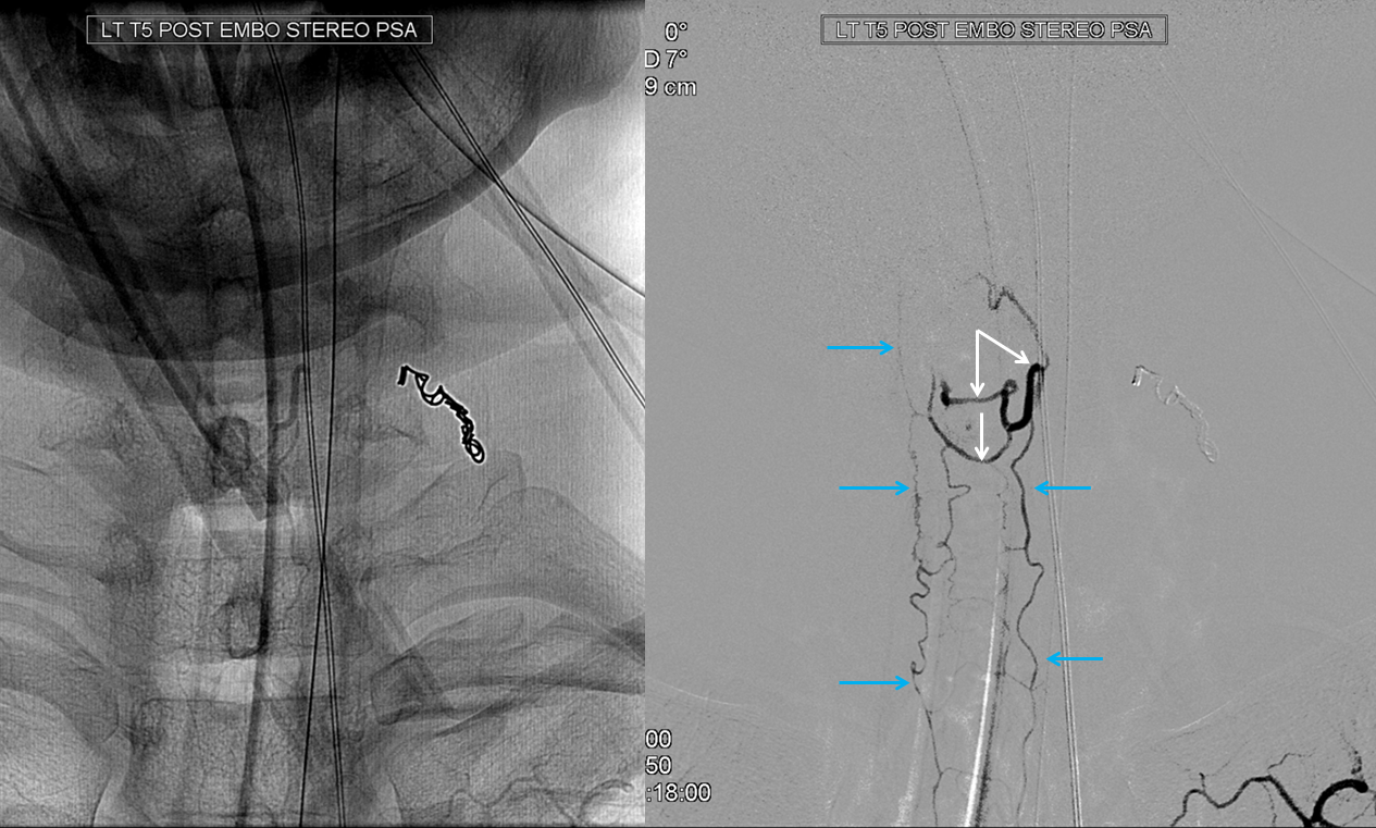 Intramedullary Spinal Cord Tumor The Neurosurgical Atlas