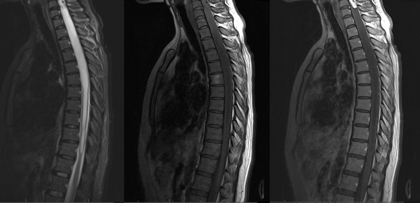 Thoracic level