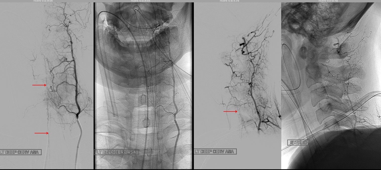 Angio deep cervical ASA