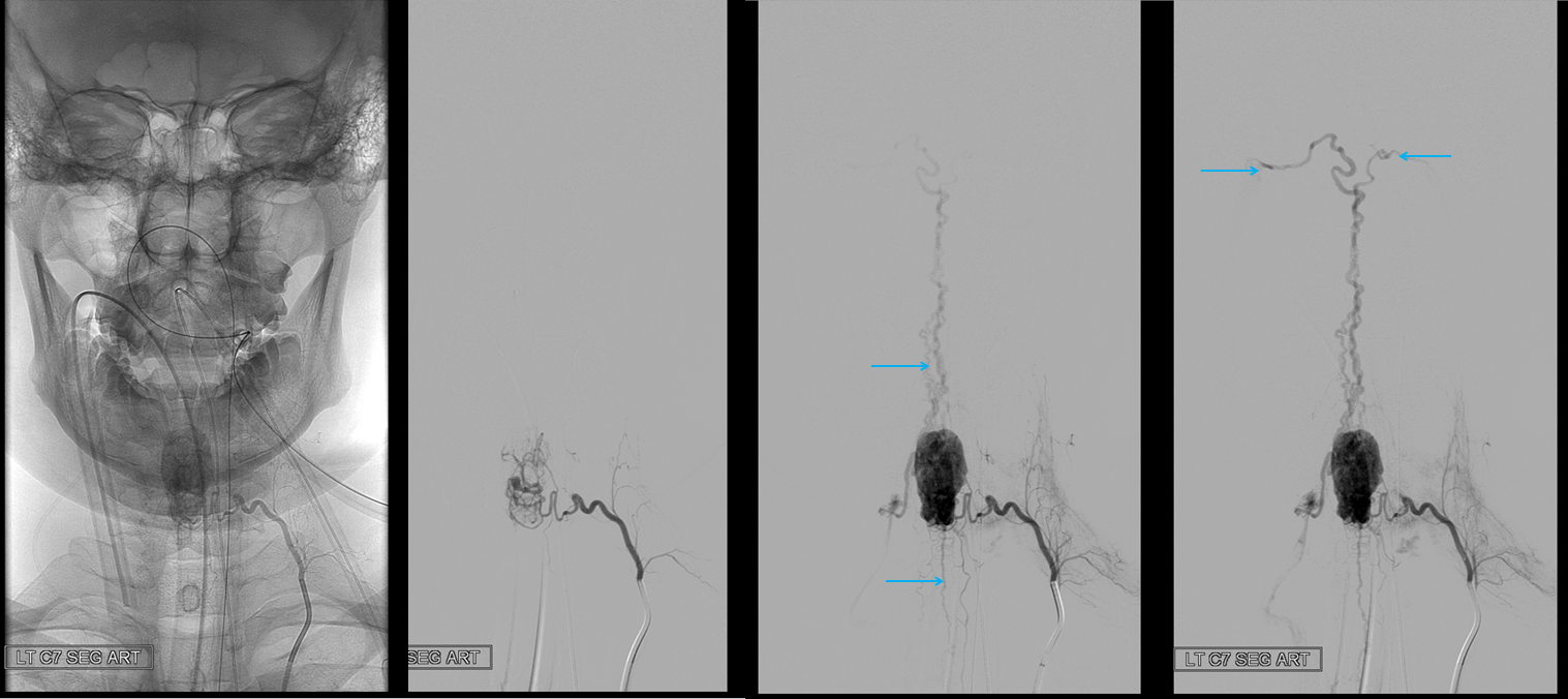 Angio Spinal Hemangiopericytoma