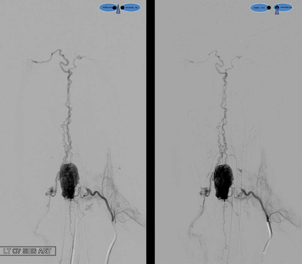 Angio Hemangiopericytoma stereo