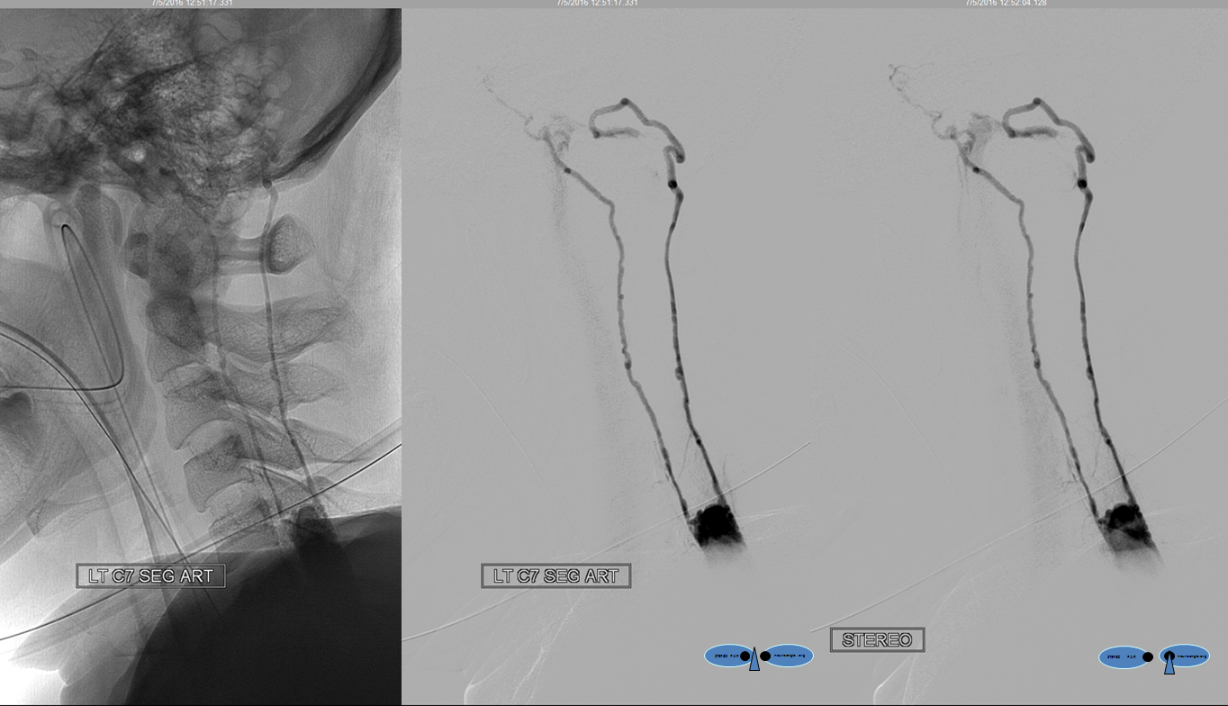 Lateral spinal hemangiopericytoma angio