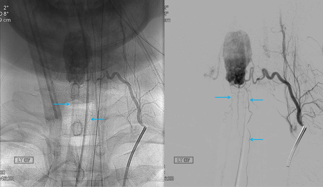 Hemangiopericytoma posterior spinal arteries