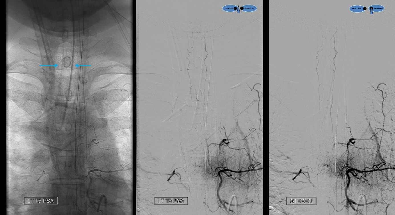 http://www.neuroangio.org/wp-content/uploads/Archives/Archives_Spinal_Intramedullary_Tumor_Embo_8.png