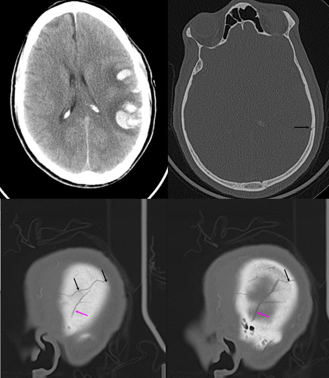 Trauma MMA fistula