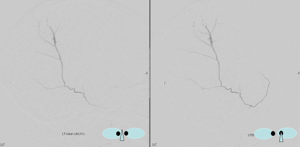 Trauma MMA fistula