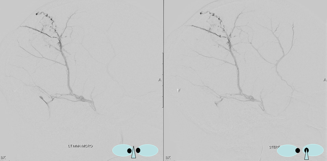 Trauma MMA fistula