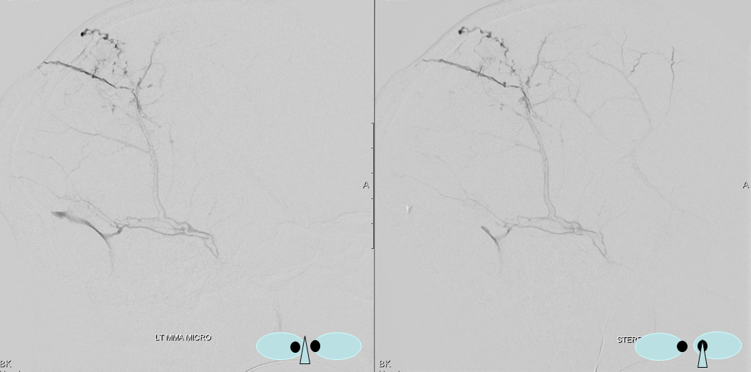 Trauma MMA fistula