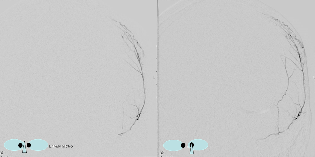 Traumatic MMA fistula