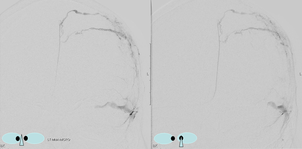 Traumatic MMA fistula