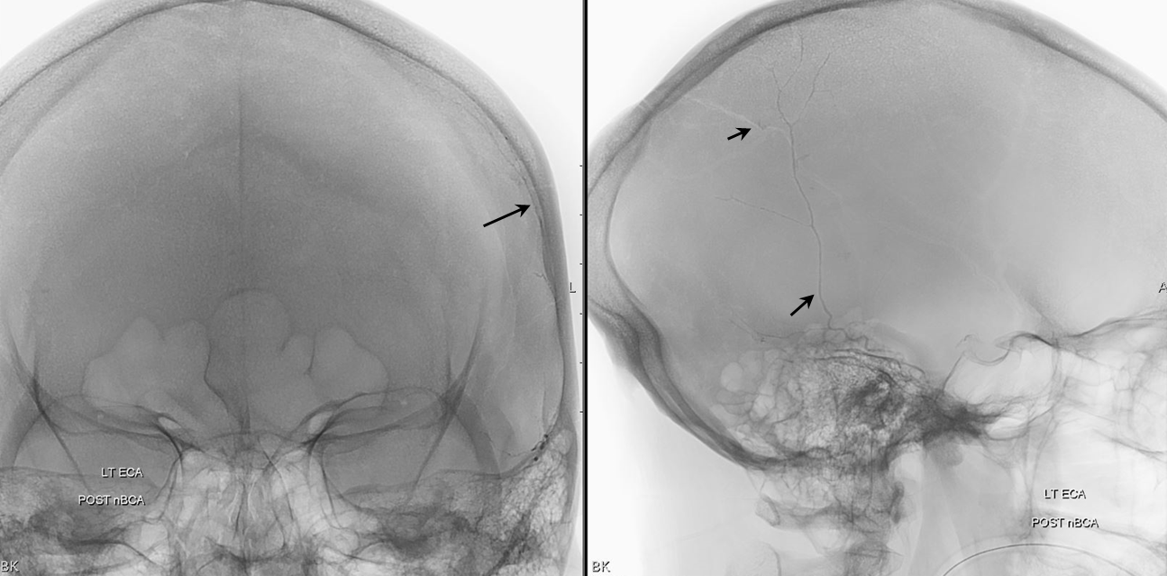 Traumatic MMA fistula