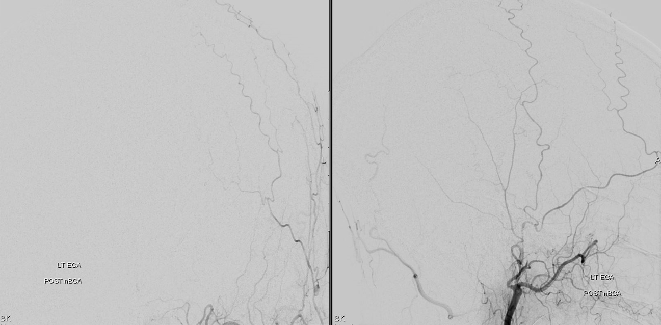 Traumatic MMA fistula