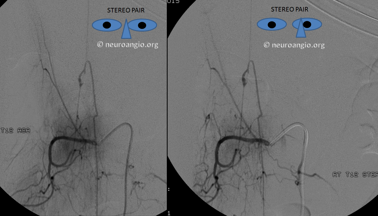 http://www.neuroangio.org/wp-content/uploads/Archives/Case_Archives_Adamciewicz_Aneurysm_1.png